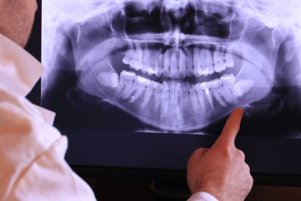 Best Emergency Tooth Extraction in Keokuk, IA